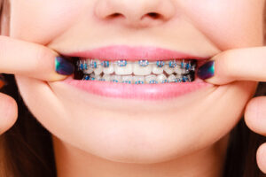 Dentist,And,Orthodontist,Concept.,Woman,Smile,Showing,Her,White,Teeth