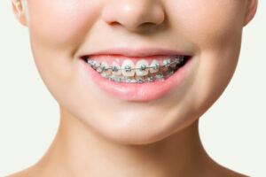 traditional metal braces